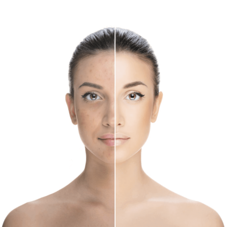 Hyperpigmentation: Understanding the Causes and Treatments