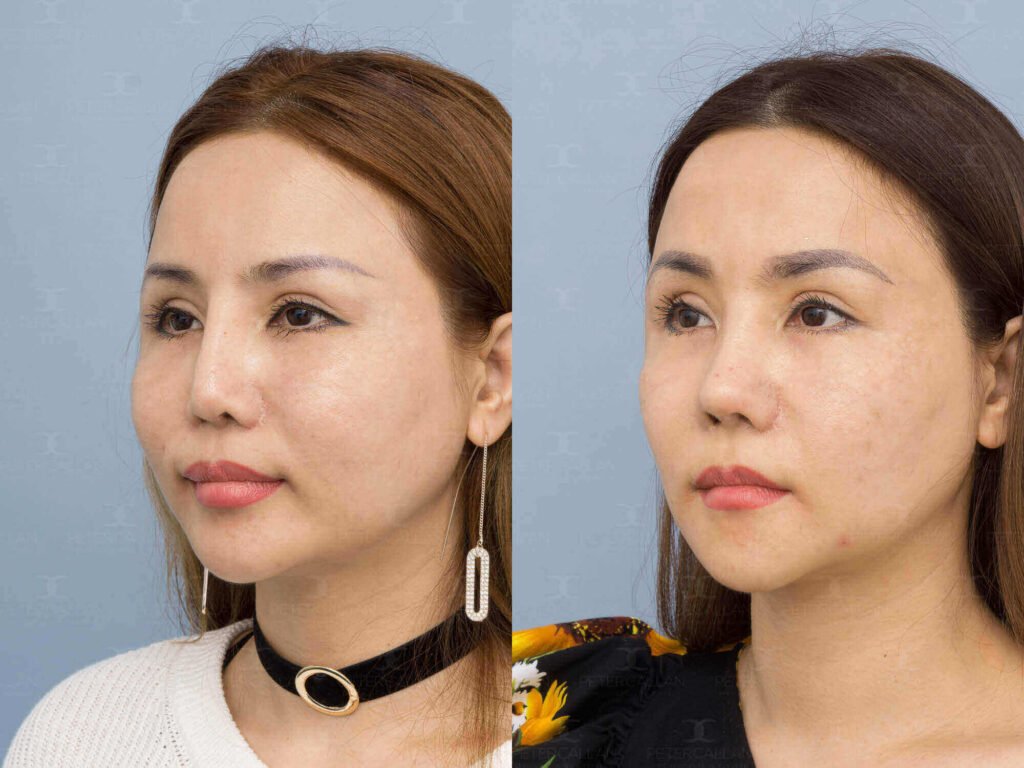Non-surgical nose job