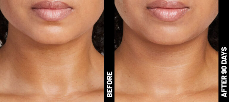 How Jawline Filler Can Help You Achieve the Perfect Jawline?